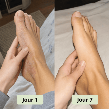 Savon Anti - Mycose DermaVerde - DermaVerde