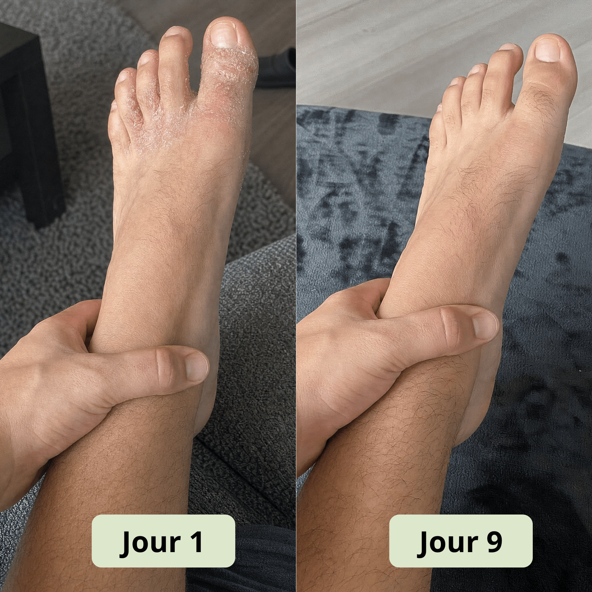 Savon Anti - Mycose DermaVerde - DermaVerde