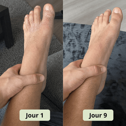 Savon Anti - Mycose DermaVerde - DermaVerde