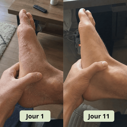 Savon Anti - Mycose DermaVerde - DermaVerde